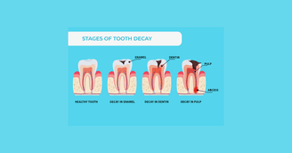 banner image for: Study Suggests Combined Use of Fluoride and Iodine Is Significantly More Effective in Preventing Tooth Decay Then Fluoride Alone